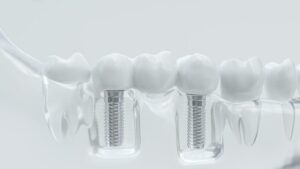 Affordable Dental implants in Brisbane