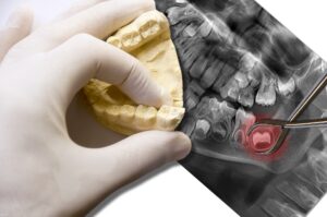 Cheap Wisdom Tooth Removal Brisbane 