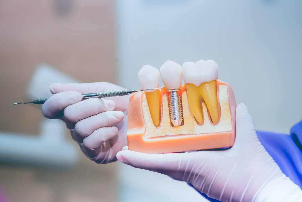 All On 4 Dental Implants In Brisbane - Everything You Need To Know