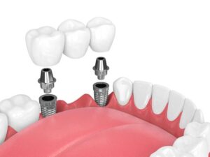 Dental Implants Are Revolutionizing Dentistry