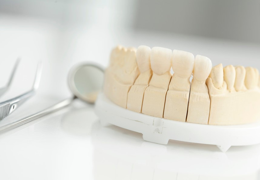 dental bridges