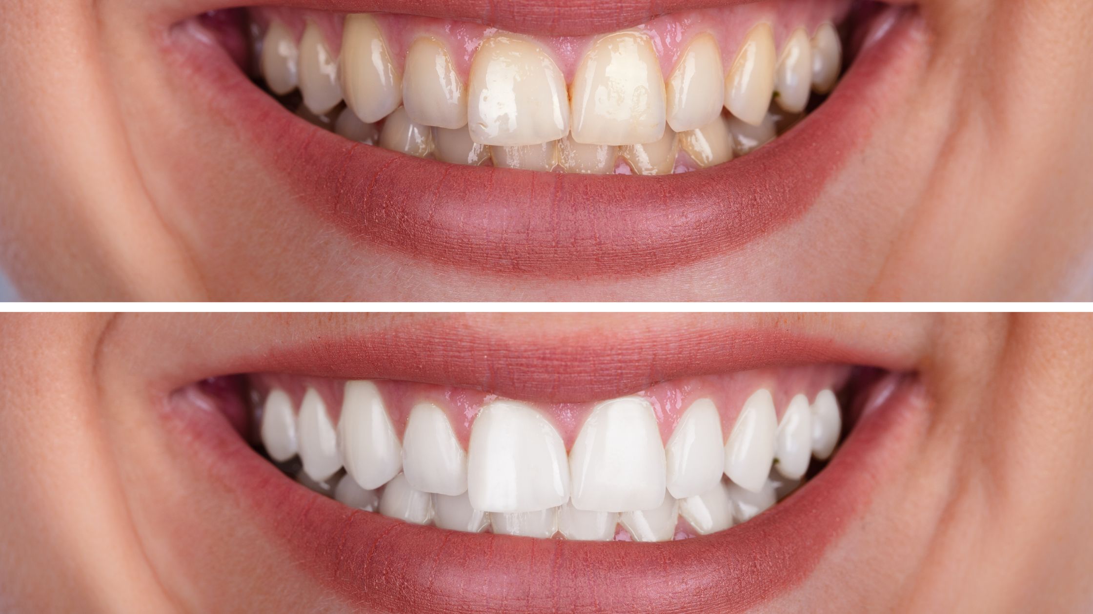 teeth whitening (1)